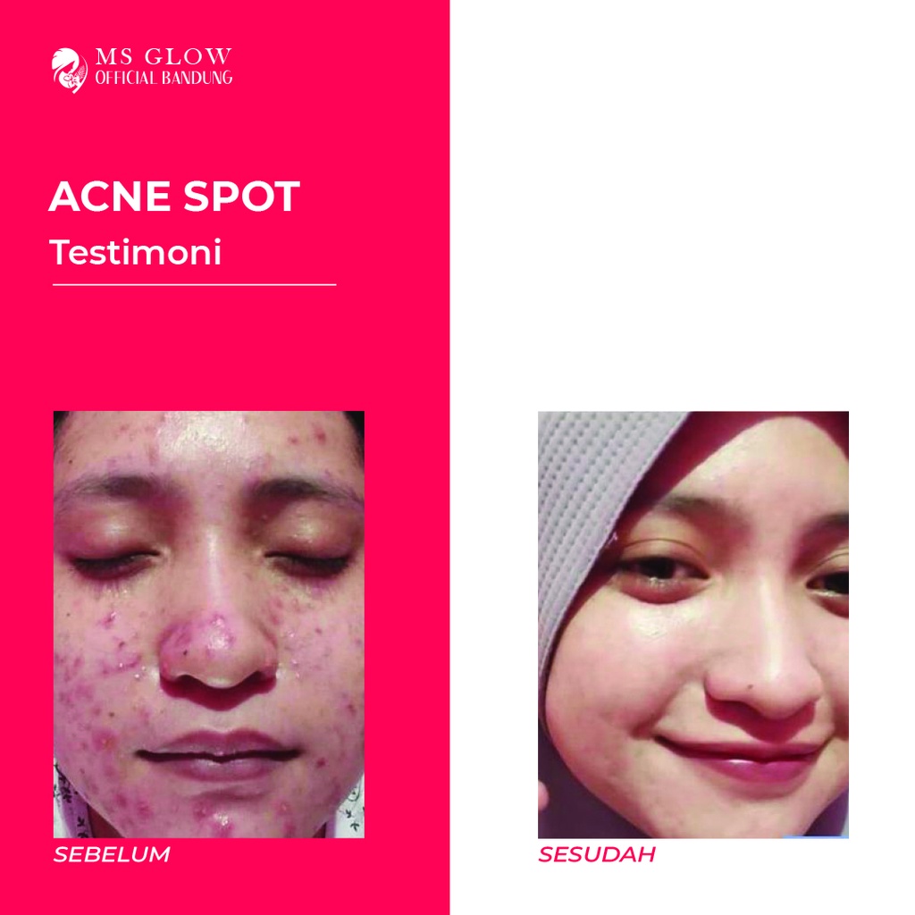 Acne Spot Ms Glow / Obat Jerawat / Perawatan Wajah Berkualitas Termurah By Msglowofficialbandung