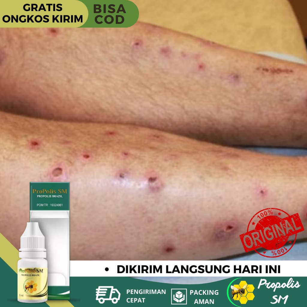 Obat Koreng, Obat Koreng Di Kaki, Obat Korengan, Obat Koreng Bernanah, Obat Koreng Gatal Di Kaki, Ob