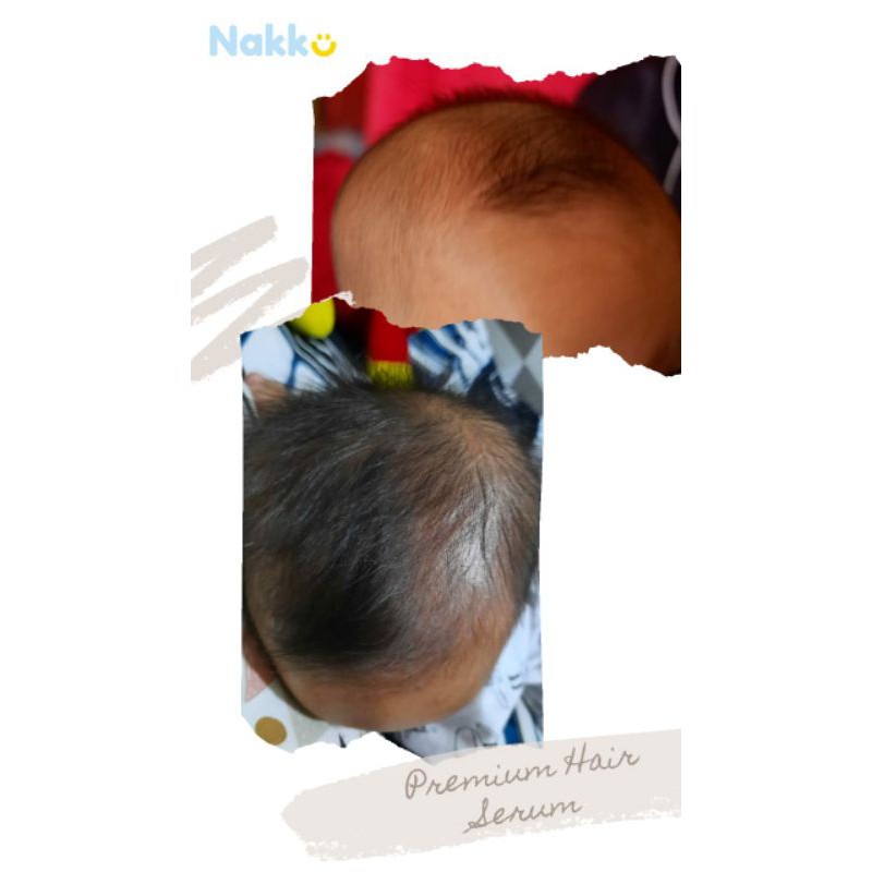 Nakku Baby Hair Serum Penebal Rambut Bayi dan Anak | Penumbuh Rambuh Anak | Bukan Minyak Kemiri Penumbuh Rambut | Serum Pelebat Rambut Anak BPOM dan BERGARANSI