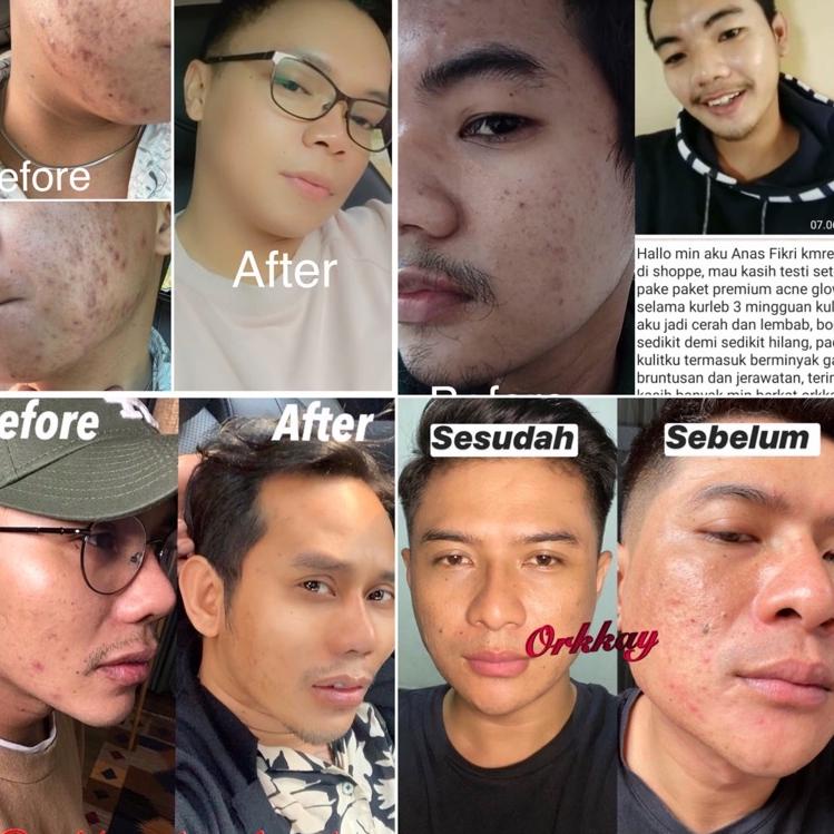 ☉ Paket Premium Acne Glow & Paket Premium White Glow Orkkay Skincare モ