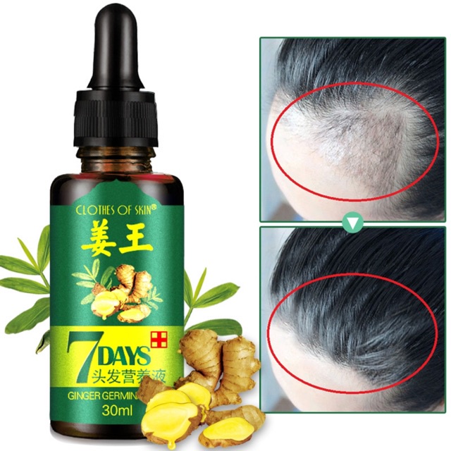 Serum Penumbuh Rambut / Anti Rontok Botak Ginger Germinal Oil-Ampuh Menumbuhkan Rambut &amp; Mencegah Kerontokkan-30ml