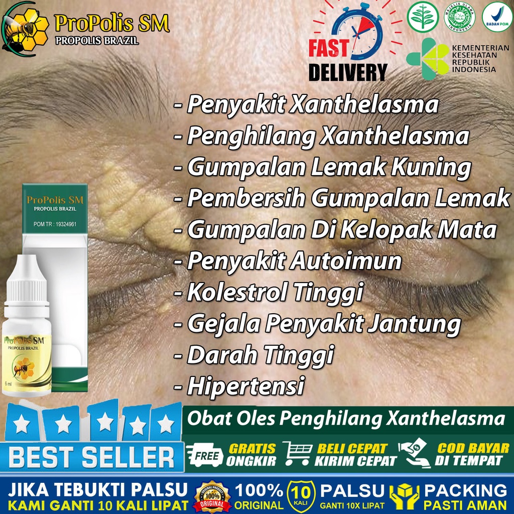 Jual Obat Oles Penghilang Xanthelasma Gumpalan Lemak Di Kelopak Mata ...