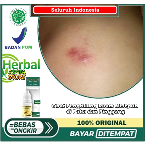 Obat Penghilang Ruam Melepuh di Paha dan Pinggang | Obat herpes zoster - Salep cacar air, gatal, pan