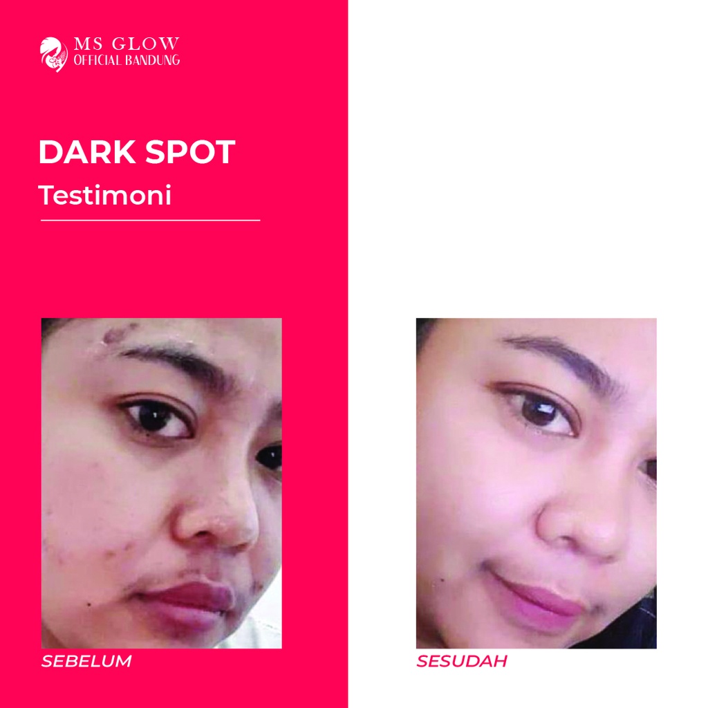 Ms Glow Dark Spot Original Serum Wajah Penghilang Flek Hitam - By ms.glowofficialbandung