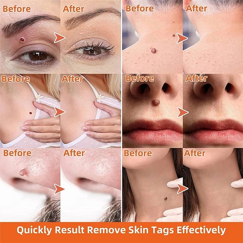 【20 gr】Skin Tag Remover Cream/Salep Obat Penghilang Tahi Lalat dan Kutil/Krim Pengilang Kutil/Wart Removal Cream