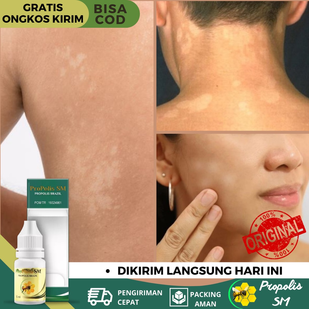 Obat Panu, Obat Panu Di Wajah, Obat Gatal Jamur, Obat Kudis Kurap Panu, Obat Panu Seluruh Badan, Oba