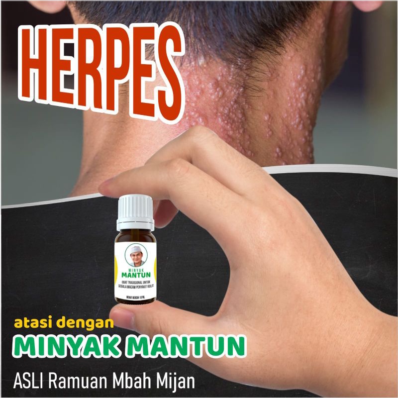 Minyak Mantun Herbal Penyakit Kulit