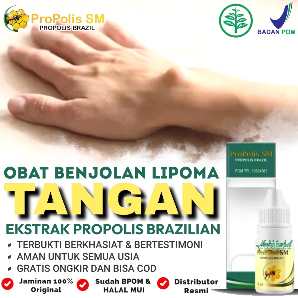 Jual Obat Benjolan Lemak Lipoma Benjolan Di Tangan Benjolan Di Perut Benjolan Di Ketiak