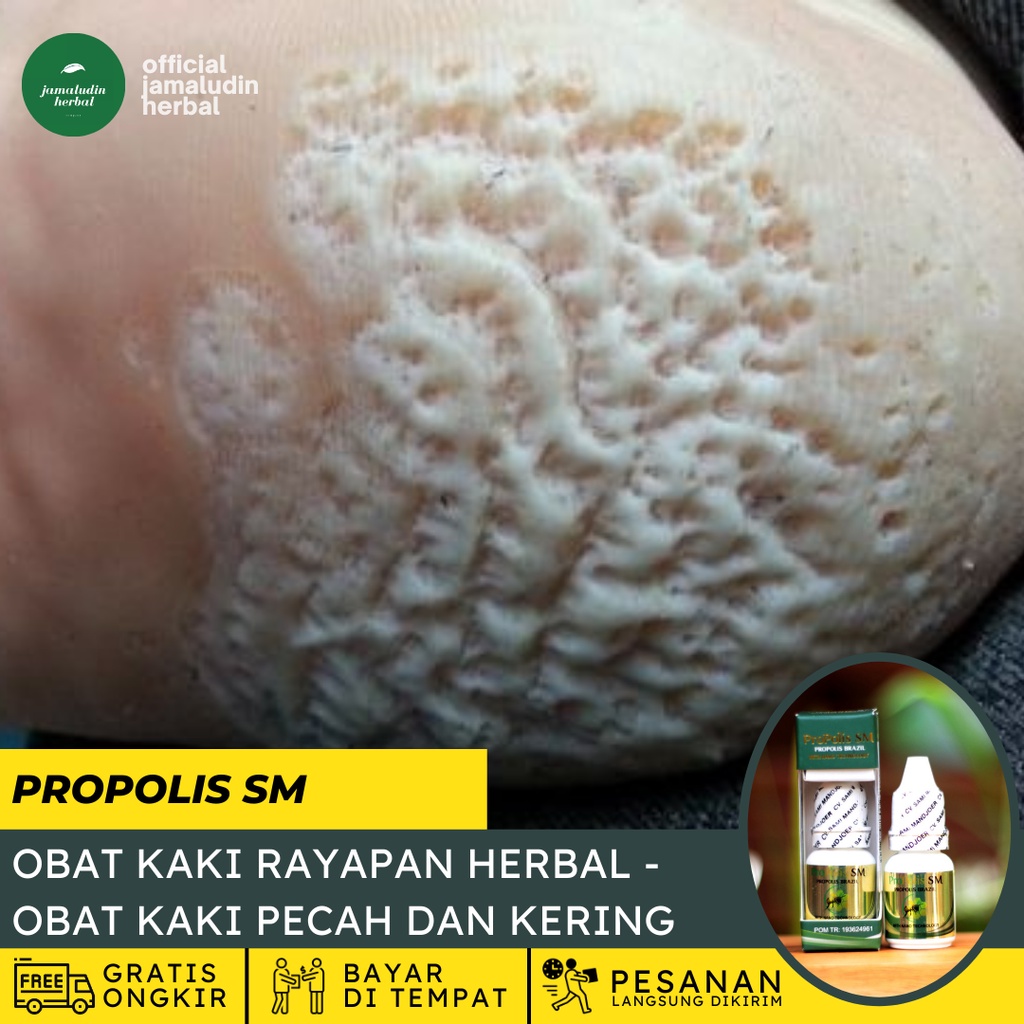 Obat Tetes Kaki Rayapan Berlubang Infeksi Bakteri, Obat Penghilang Kaki Rayapan Kasar Kering Bau, Ob
