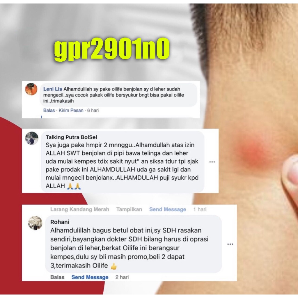 Obat Benjolan Lipoma Obat herbal Cina Krim lipoma 30g Perawatan punggung/leher/paha Kanker Tumor Kelenjar Tiroid Lipoma