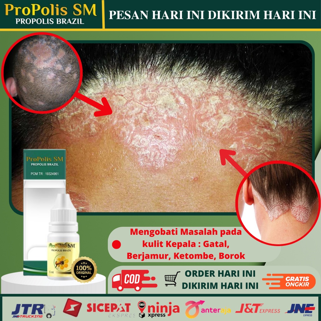 Obat Tetes Kulit Kepala Gatal - Obat Gatal Kulit Kepala - Jamur Di Kepala - Psoriasis - Obat Borok K