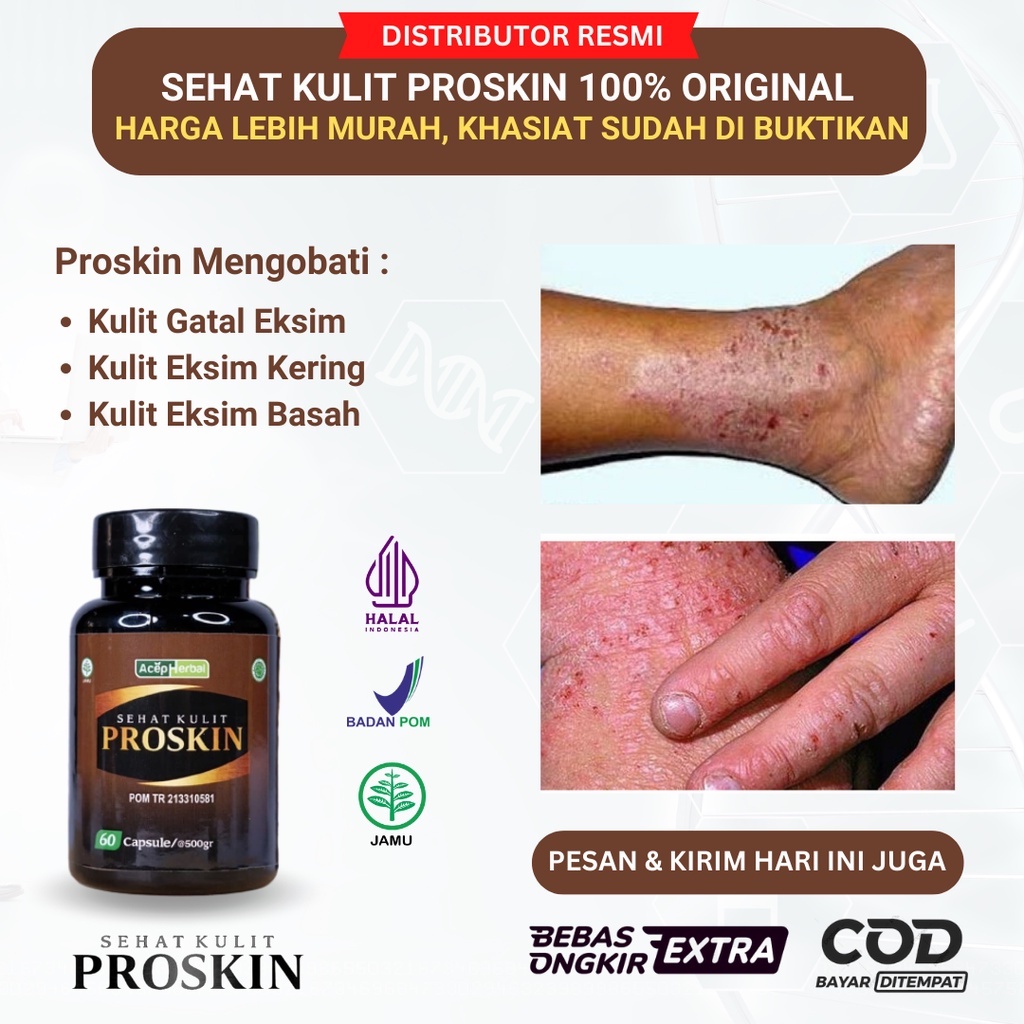 Obat Gatal Eksim, Obat Gatal Kulit Eksim Kering, Obat Gatal Kulit Eksim Basah, Obat Gatal Kulit Berk