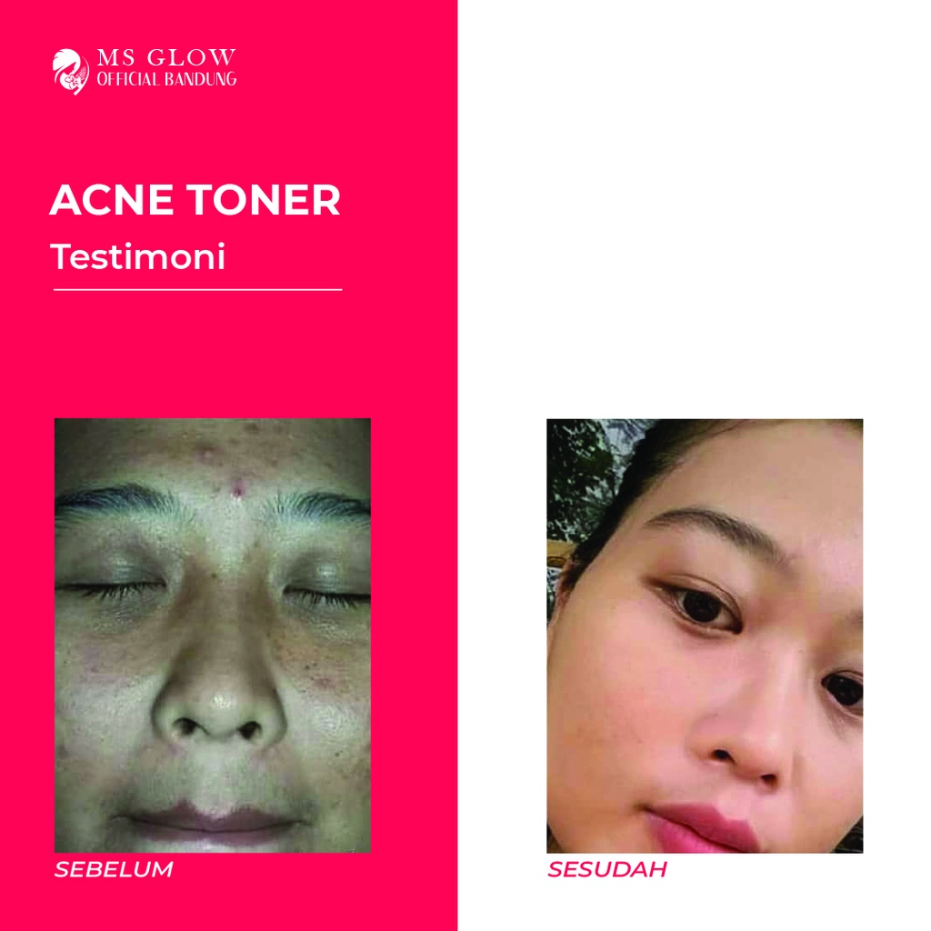 Acne Toner MS Glow / Pembersih / Perawatan Wajah Untuk Jerawat Termurah - By Msglowofficialbandung