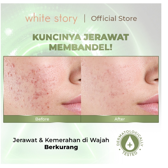 WHITE STORY Acne Soothing Series - Wajah Berjerawat &amp; Beruntusan