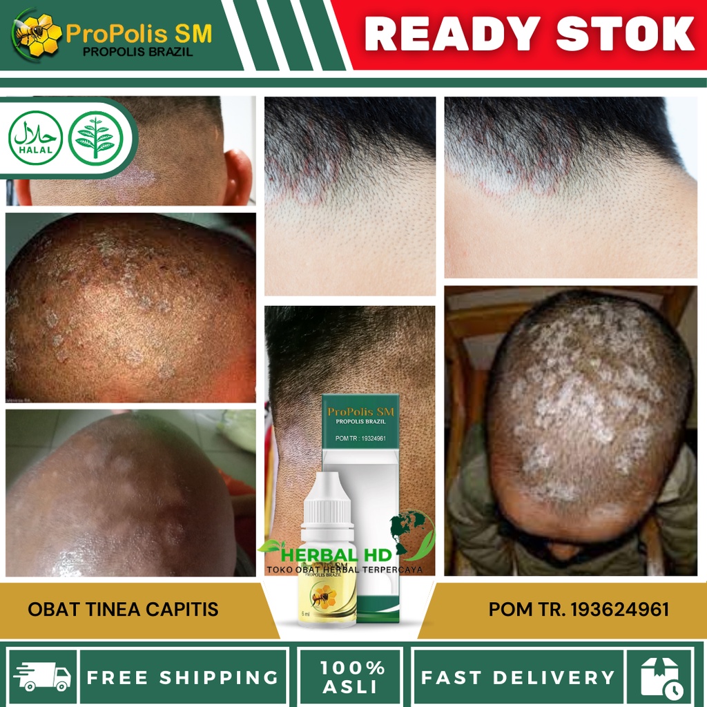 Obat Tinea Capitis - Obat Infeksi Jamur Di Kepala, Obat Gatal Kulit Kepala, Obat Kulit Kepala Berker