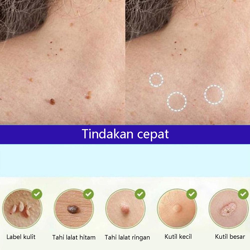 20G Obat Perontok Kutil, Obat Papiloma Penghilang Kutil,Obat Mata ikan,Kutil,Kapalan Wanita - Salep Kutil Kelamin - Obat Papiloma Di Leher, Repair And Clean Skin Tag Remover