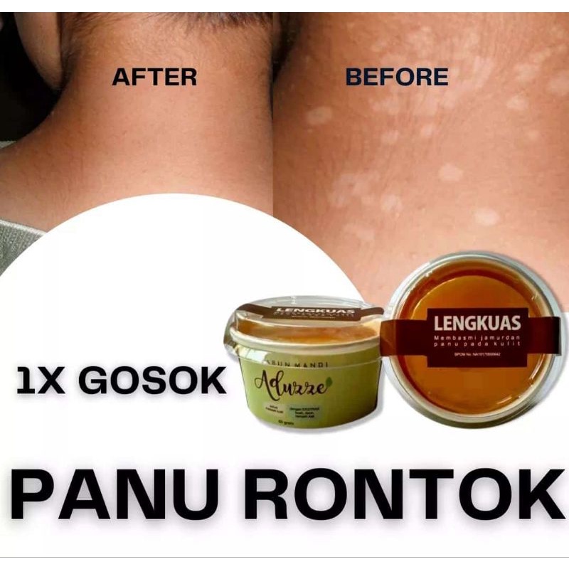 SABUN PANU PALING AMPUH dari SABUN HERBAL ADUZZE LENGKUAS GROSIR untuk Wajah & Badan Anti Panu Jamur