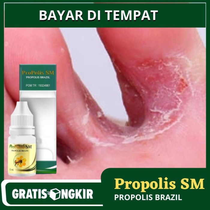 Saku Obat Kutu Air, Obat Kutu Air Alami, Kutu Air Membandel, Obat Kutu Air
