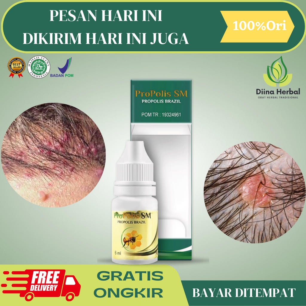 Obat Folikulitis, Obat Benjolan Di Kulit Kepala, Obat Benjolan Merah Kecil Di Kulit Kepala, Obat Inf