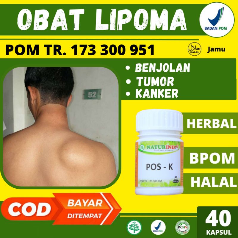 Jual Obat Lipoma Benjolan di Leher Ketiak Punggung Lengan Kelenjar