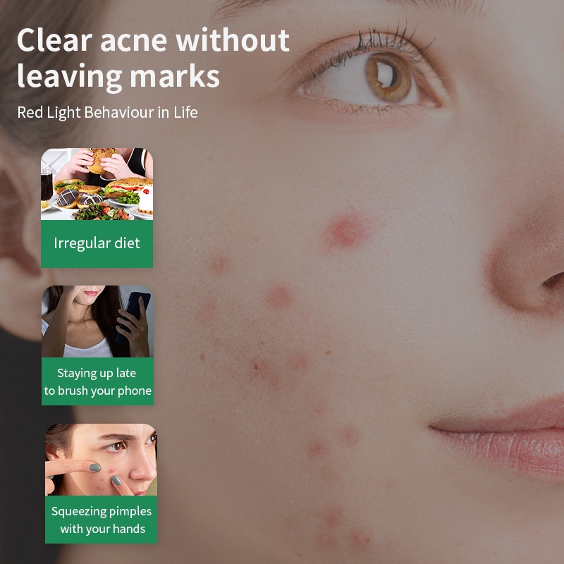 YOUBUY Acnes Sealing Gel 18G / Acne Gel / Gel Jerawat / Acne Care