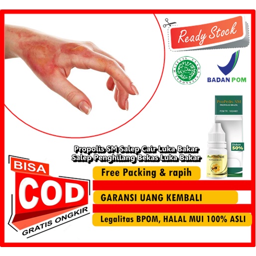 Propolis SM Salep Cair Luka Bakar, Salep Penghilang Bekas Luka Bakar, Kulit Melepuh, Penanganan Luka