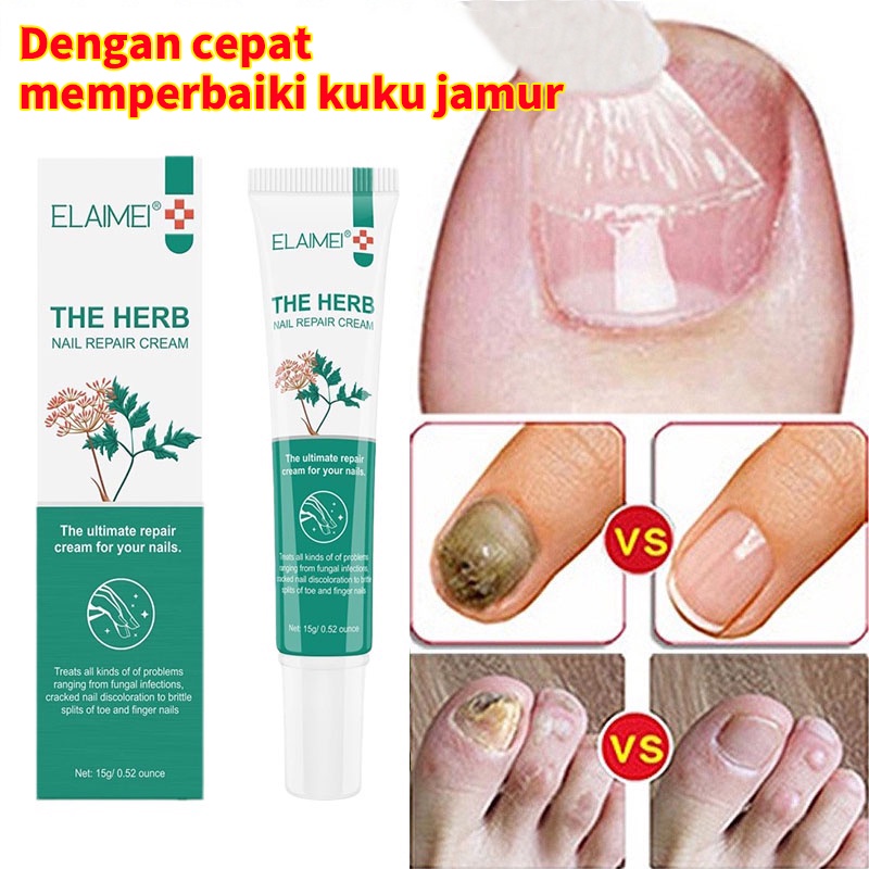 Krim perbaikan kuku Aman tidak sakit/Perawtan kuku Anti virus Mengatasi gatal Serum menghilangkan onokomikosis/Krim kuku jamur Krim perbaikan memperbaiki kuku jamur