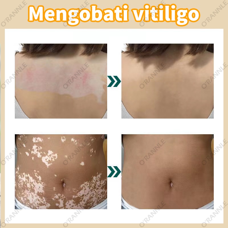 【100% Asli】Mengobati vitiligo Bintik keringat  Bintik belang Vitiligo Bercak putih lainnya Ampuh obat vitiligo paling ampuh  Obat Khusus untuk Vitiligo