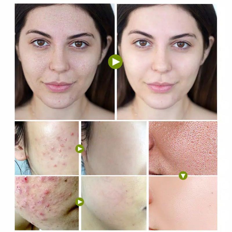 BREYLEE Acne Treatment Cream Anti Acne Pimple Removal Spots Oil Control Shrink Pores Moisturizing