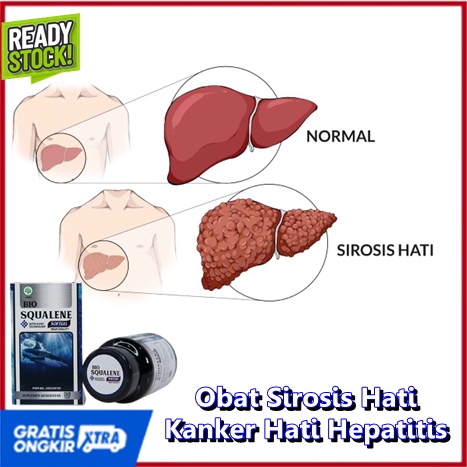 obat sirosis -  Obat sirosis hati -  Obat sirosis kanker hati -  Obat sirosis hepatitis -  Obat herb