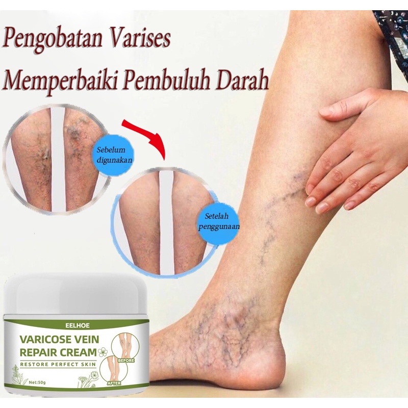 Varicose Veins Treatment Cream Salep Vaskulitis Flebitis Spider Herbal Cream Varises Krim Perawatan 