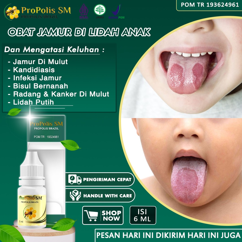 Obat Jamur Di Lidah Anak Kandidiasis Mukokutan Lidah putih Jamur Di Mulut Radang Kanker Sariawan Ana