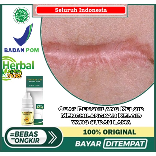 Obat Penghilang Keloid, Menghilangkan Keloid yang sudah lama, Bekas jahitan yang menonjol, Keloid Be