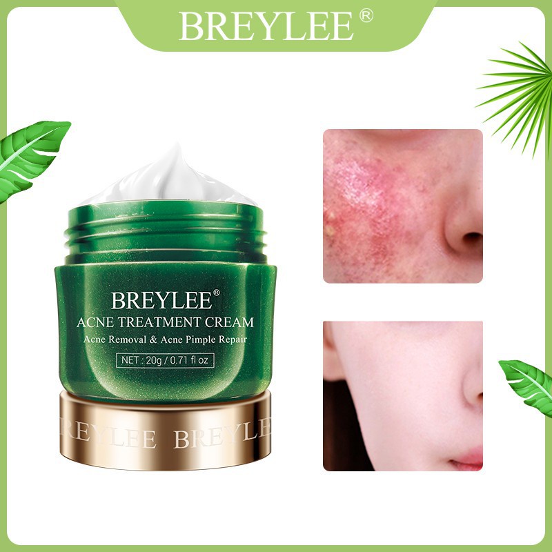 BREYLEE Acne Treatment Cream Anti Acne Pimple Removal Spots Oil Control Shrink Pores Moisturizing