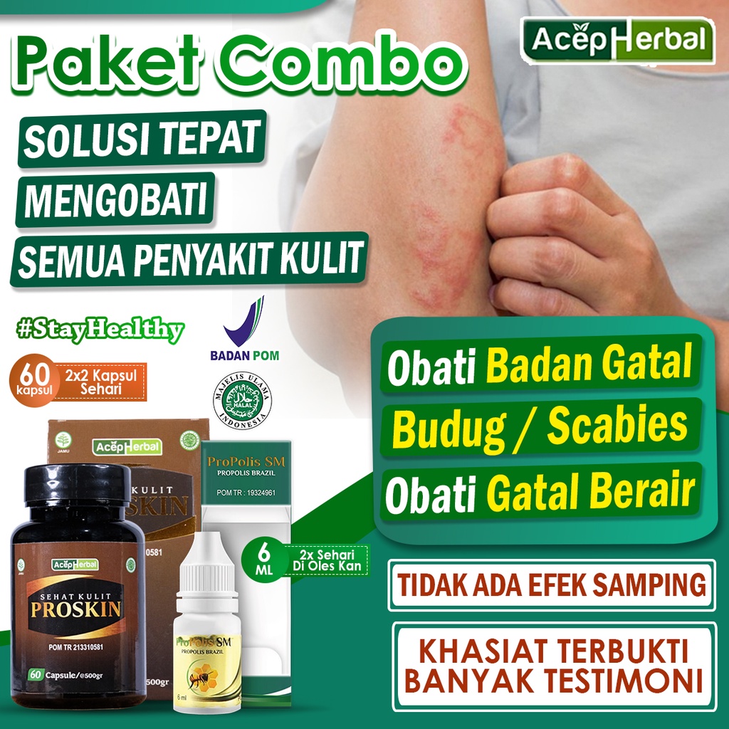 Jual Obat Badan Gatal Buduk Kulit Gatel Berair Di Jari Tangan Dan Kaki Ruam Kulit Bercak Bintik 5700