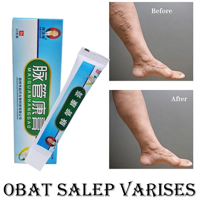 Mai Guan Kang Gao Salep Mengobati Varises / Maiguankanggao Krim Obat Varises Kaki / Krim Penghilang Varises Kaki / Obat Cina Herbal Untuk Varises Kaki / Krim Salep China Untuk Pengobatan Varises Kaki / Salep Varises Ampuh / Varicose Veins Treatment Cream