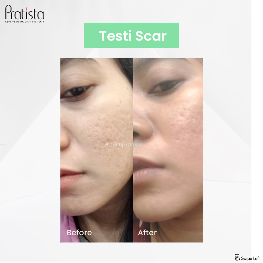 Krim Pagi Wajah Berjerawat Centella Day Cream SPF 30 Pratista Skincare Wajah Atasi Jerawat Beruntusan Komedo Ori BPOM