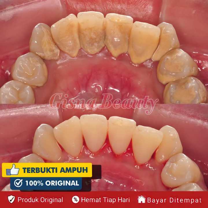 Odol pemutih gigi permanen asli bpom Pasta Gigi Nasa Pemutih Gigi Perontok Karang Gigi Kuning Asli 1