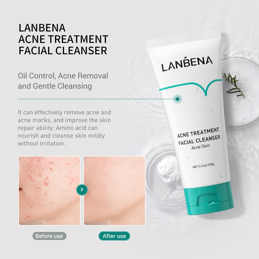 (READY &amp; ORI) LANBENA ACNE TREATMENT FACIAL CLEANSER LB5569