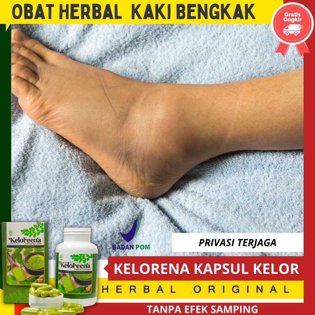 obat untuk kaki gajah, obat herbal kaki gajah, Kaki Bengkak, kaki bengkak setelah digigit nyamuk [ K