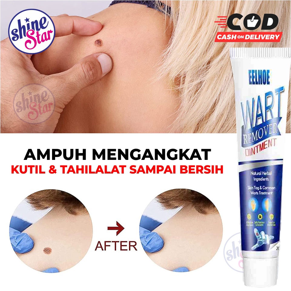 SHINE STAR -  Eelhoe Skin Tag Remover Menghilangkan Kutil Tahi Lalat Mata Ikan Wart