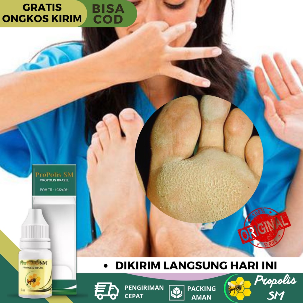 Obat Kaki Rayapan, Obat Kaki Rayapan Dan Bau, Obat Kaki Rayapan Berlubang, Obat Telapak Kaki Bolong-