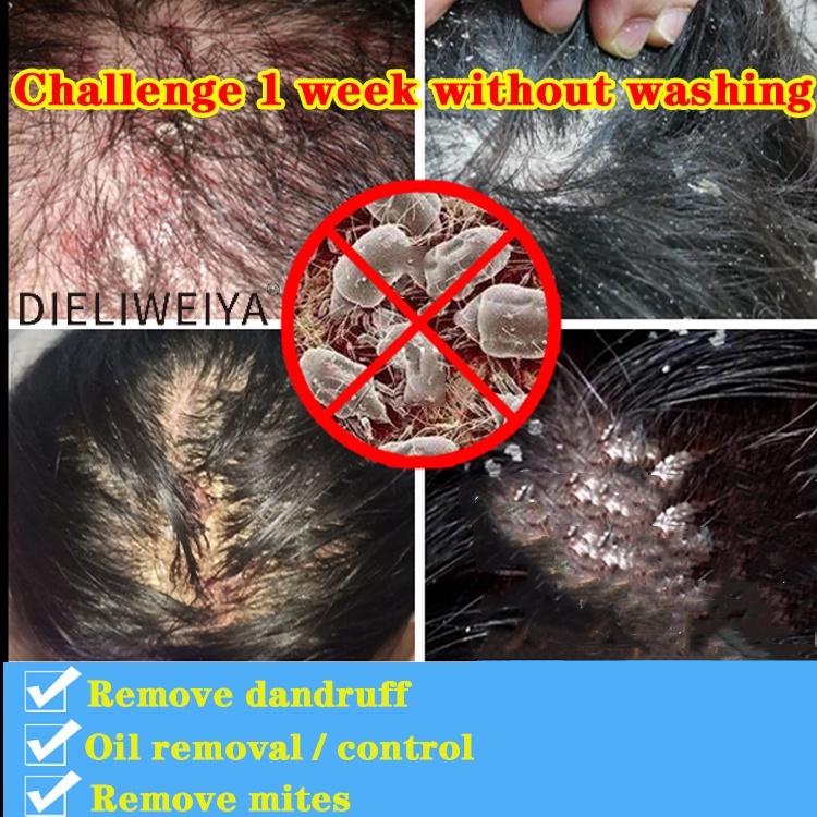 [COD] Shampo anti ketombe Sampo anti ketombe  anti ketombe Obat ketombe 500ml memperbaiki rambut kusut dan kontrol minyak shampo halus lembut dan anti lepek dandruff treatment dermatitis seboroik