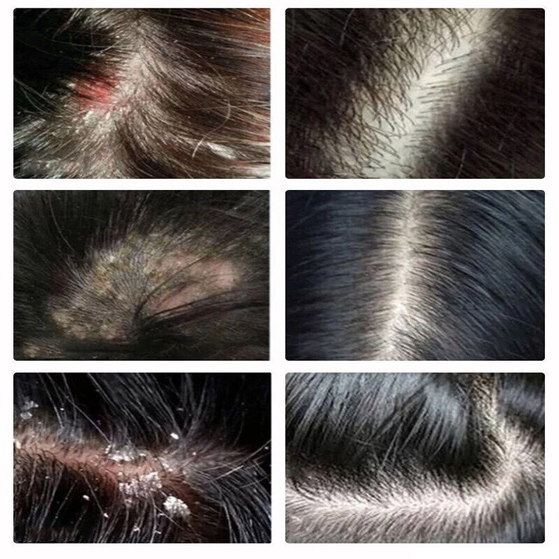 [COD] Shampo anti ketombe Sampo anti ketombe  anti ketombe Obat ketombe 500ml memperbaiki rambut kusut dan kontrol minyak shampo halus lembut dan anti lepek dandruff treatment dermatitis seboroik