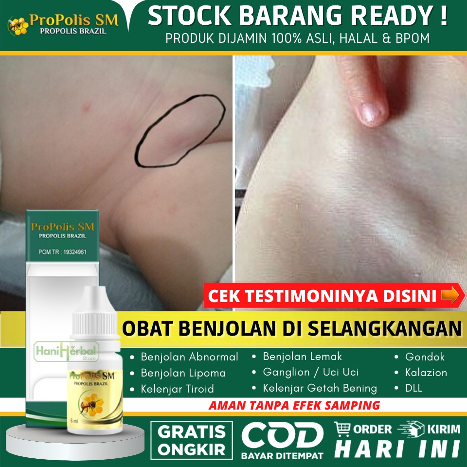 Obat Penghilang Lipoma di Selangkangan, Obat Benjolan Lunak / Keras di Selangkangan, Obat Sekelan di