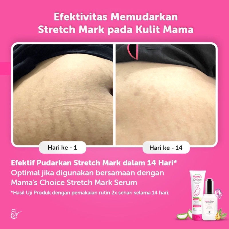 Mama's Choice Stretch Mark Cream 100ml Krim Penghilang Strechmark Termurah By Lidyamomnbaby