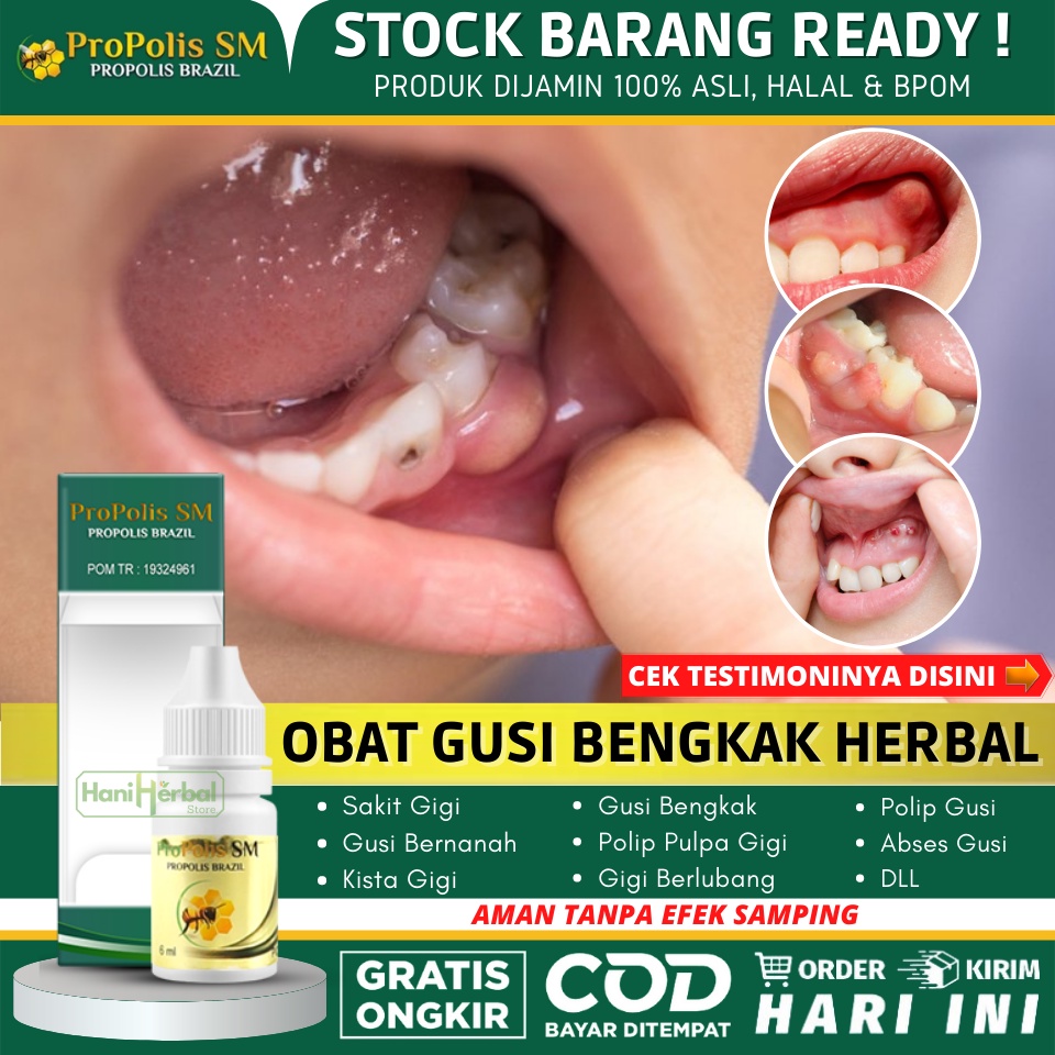 Obat Gusi Anak Bengkak Bernanah 100% Alami - Obat Sakit Gigi Herbal Untuk Anak, Obat Penghilang Benj