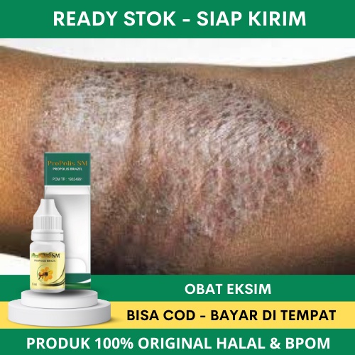 Obat Eksim Kering Menahun - Obat Herbal Eksim Kering - Obat Oles Exim - Obat Penghilang Gatel - Obat