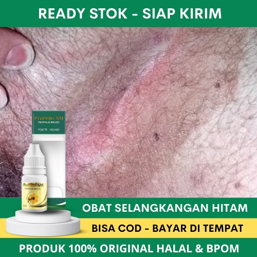Obat Selangkangan Hitam, Obat Selangkangan Hitam dan Jamur, Obat Pembersih Jamur di Selangkangan, Ob
