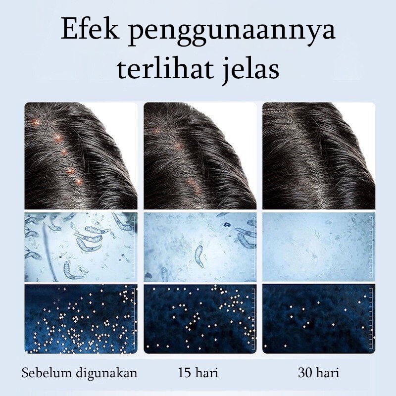 Anti-dandruff shampoo Sampo anti ketombe Shampo anti rontok Pengontrol minyak, anti-gatal, anti-ketombe, anti-penumpahan Bahan garam laut impor, penghilangan tungau 99%.Shampo anti ketombe dan anti gatal paling ampuh di Indonesia